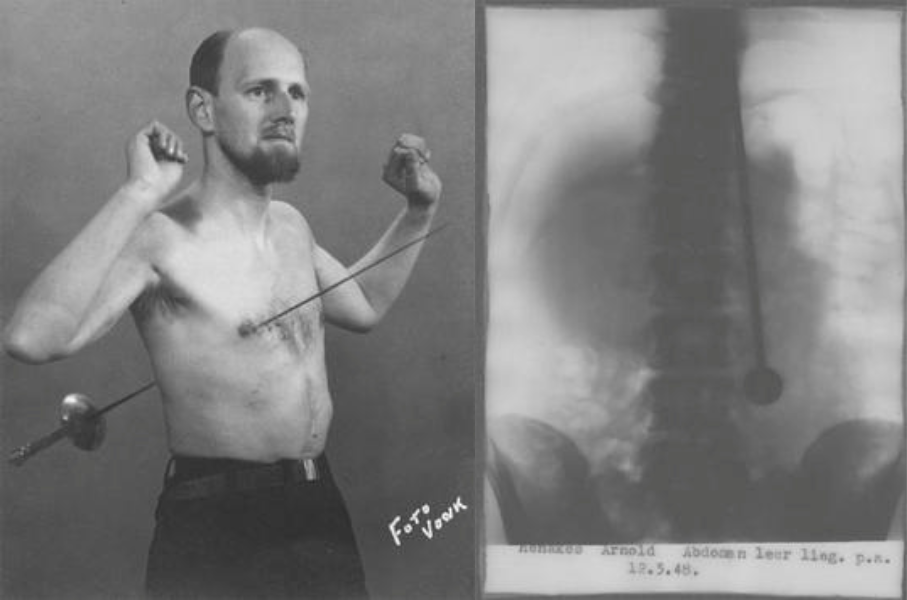 長剣を貫通させるミリン・ダヨ（左）公開検査で撮影されたレントゲン写真（右）