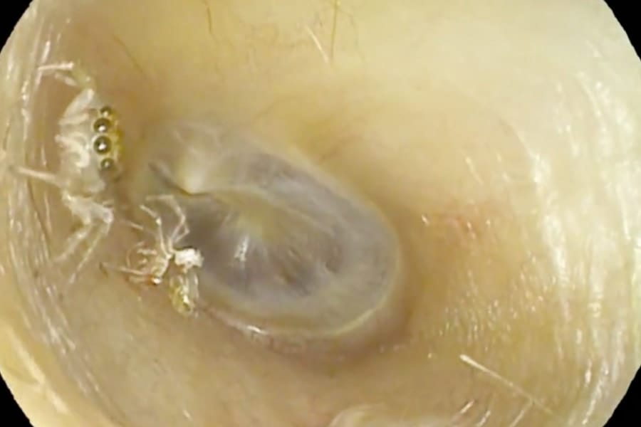 耳の中を這い回り脱皮までしていた「クモ」の動画が医学誌に報告される！