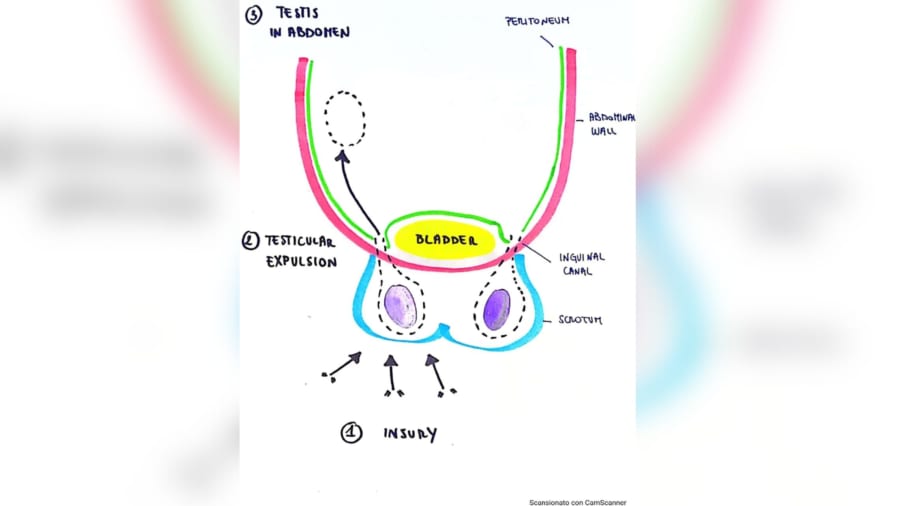 症例報告書に描かれた男性の右睾丸が腹部にどのように押し込まれたかを示す図