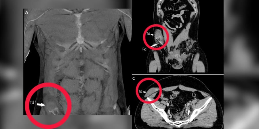 CTスキャンの結果、男性の睾丸が腹部まで大きく移動していたことが判明した