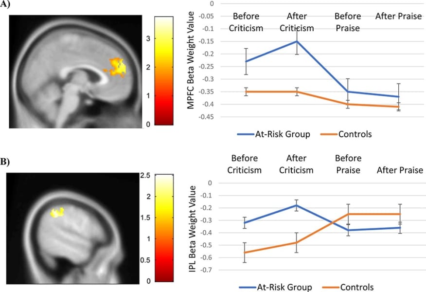 うつ病のリスクがある人は、批判を聞いた後、2 つの DMN 領域 (A) 内側前頭前皮質 と (B) 下頭頂小葉 で著しく高い活性化を示しました