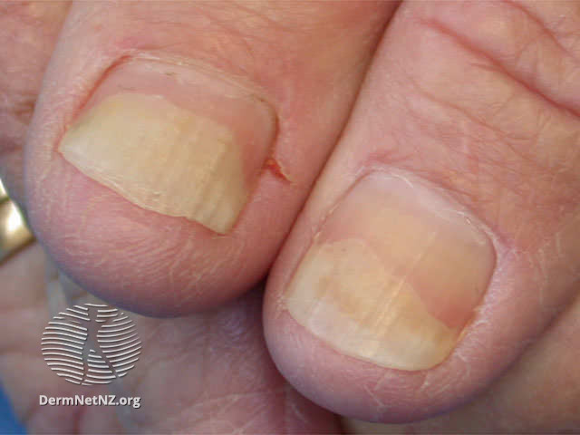 爪甲剥離症の一例