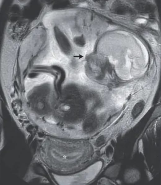 腹腔で発育していた胎児の画像（その下の星印で示されたのが子宮）