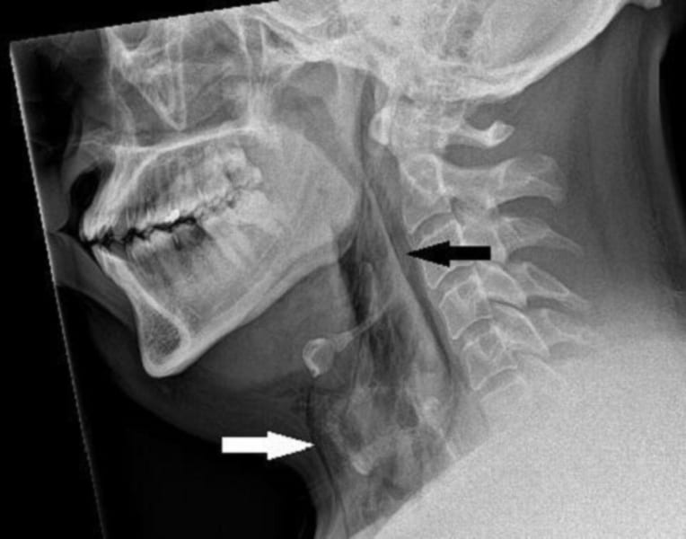CTスキャンで確認された裂け目の箇所（矢印）