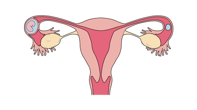 卵管に受精卵が着床するイメージ（そこで発育すると卵管が破裂する危険性も）