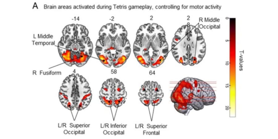 頭の中でブロックを回転させる指示を受けた参加者の脳画像。視覚空間処理に関与する後頭葉、側頭葉、前頭葉が活性化している。