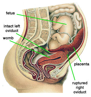 腹腔妊娠のイメージ（womb:子宮、placenta:胎盤、ruptured right oviduct:卵管の破裂部分）