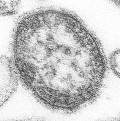 麻疹ウイルス、世界全体では年間20万人が感染している