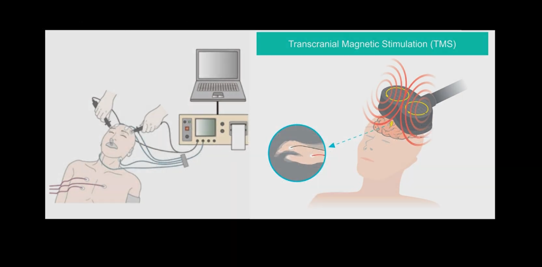 左：電気けいれん療法、右：反復経頭蓋磁気刺激