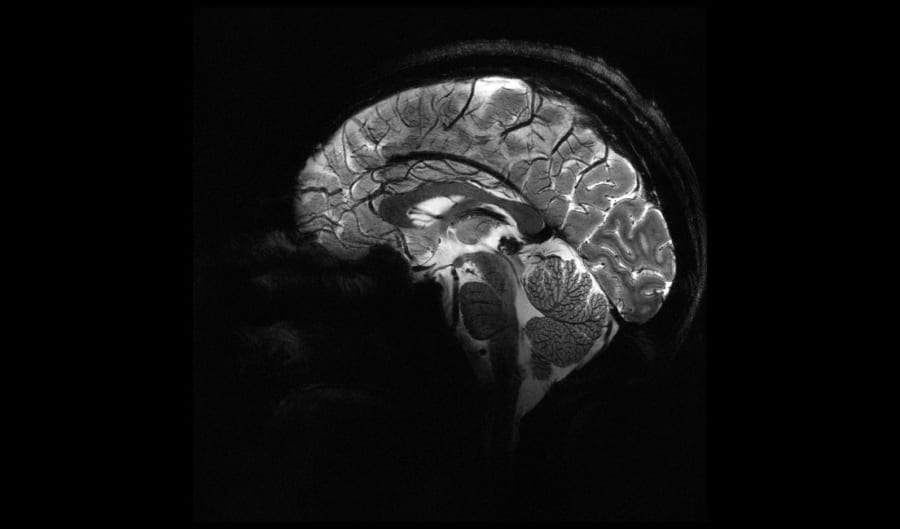 イズールトで撮影した脳画像