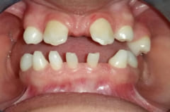 歯の数が少ない先天性無歯症の一例。