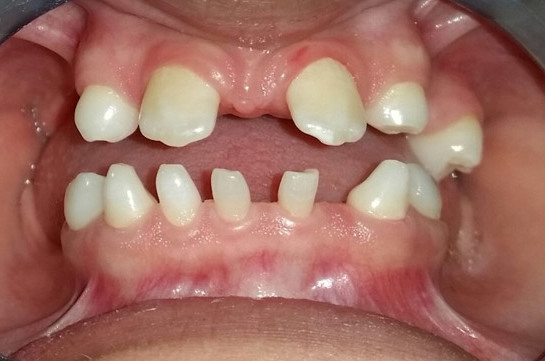歯の数が少ない先天性無歯症の一例。