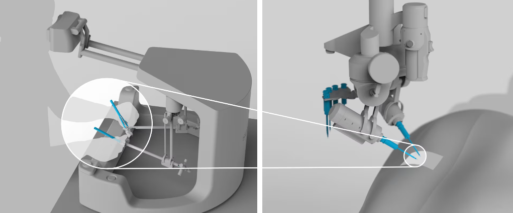 マイクロサージャリーをサポートする外科用ロボット
