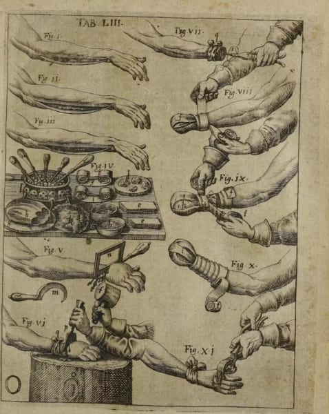 17世紀の腕切断に関する論文。木槌とノミを使うよう指示している