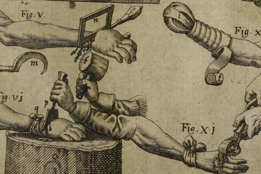 「木槌」と「ノミ」で腕を切断！ヨーロッパの四肢切断と義手の歴史