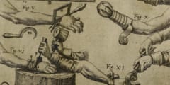 17世紀の腕切断に関する論文