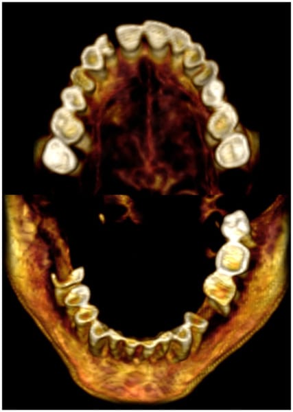 歯のスキャン画像