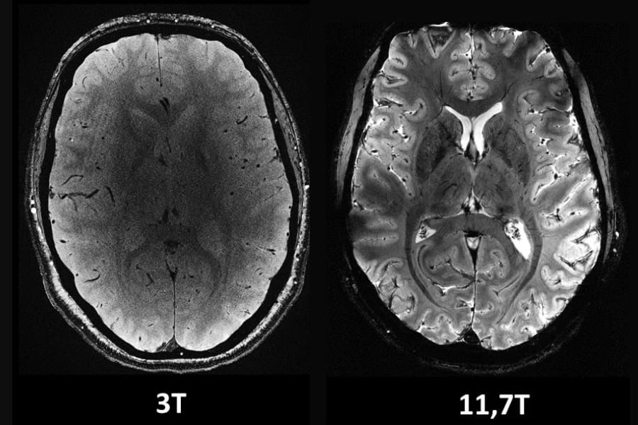 脳が鮮明に見える！世界最強の磁束密度で脳をスキャンするMRI「イズールト」