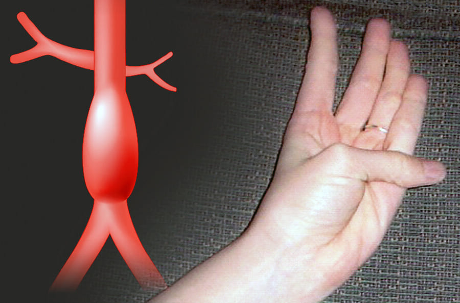 親指の伸びで「大動脈瘤の有無」がすぐ分かる？片手診断テストが有効だと発表