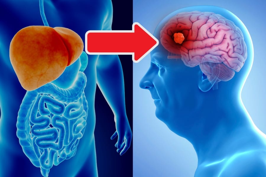 アルツハイマー病の原因「アミロイドβ」の発生源は肝臓の可能性がある